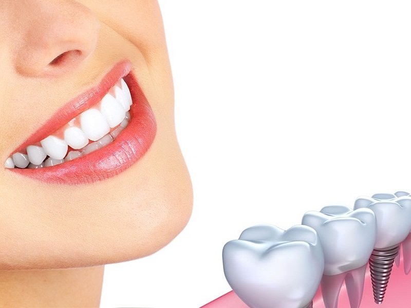 Dịch vụ cấy ghép răng implant tại nha khoa Tây Đô