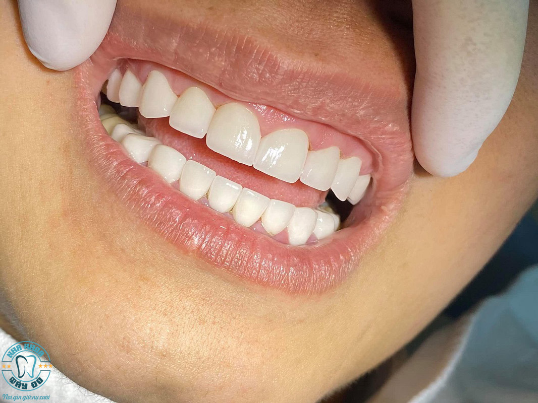 Dịch vụ bọc răng sứ tại Nha Khoa Tây Đô